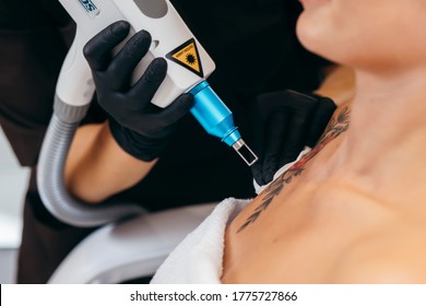 Laser Tattoo Removal From Shoulder