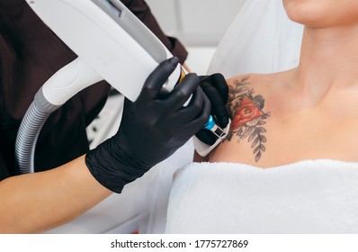 Laser Tattoo Removal From Shoulder