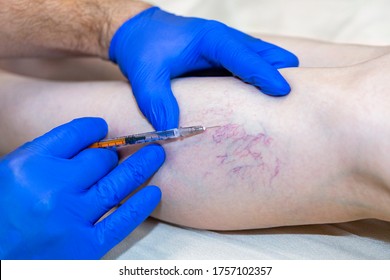 Laser treatment of varicose veins on the leg with anesthesia
