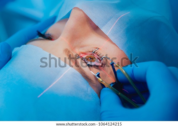 Laser vision correction. A
patient and team of surgeons in the operating room during
ophthalmic surgery. Eyelid speculum. Lasik treatment. Patient under
sterile cover