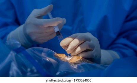 Laser vision correction.Team of eye surgeons in the operating room during ophthalmic retina surgery. Lasik or gluacoma treatment on eyeball.Patient under blue sterile cover. Cararact lens replacement.