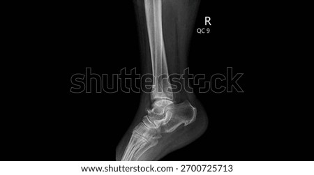Lateral ankle X-ray showing tibia, fibula, talus and tarsal bones. Medical diagnostic imaging for orthopedic evaluation and ankle joint assessment.