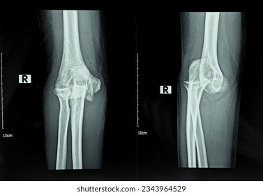radiografía lateral y anteroposterior lisa o radiografía de una articulación codo derecha que muestra la dislocación de la articulación codo después de un accidente en un paciente varón. radiografía de película. concepto médico.