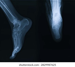 Lateral and AP view X-ray scan of human foot and ankle showing tarsal bones and phalanges