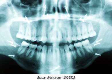 Lateral Ceph jaw x-ray showing screws used to reconstruct the jaw bones.