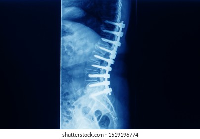 A Lateral Lumbar Spine X-ray In A Patient With Spinal Canal Stenosis And Degenerative Disc Disease Showing Pedicle Screw Implant After Surgical Decompression And Spinal Fusion.