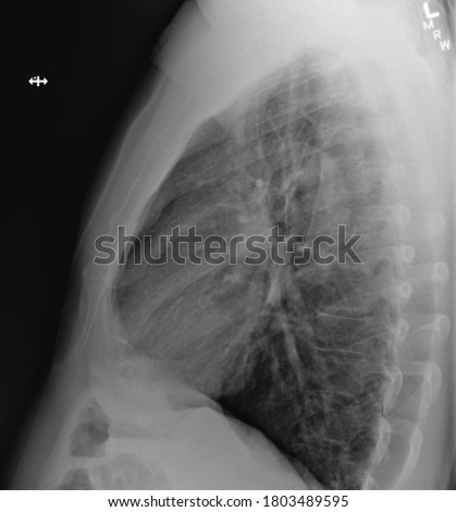 Lateral lung x-ray side view healthy lungs