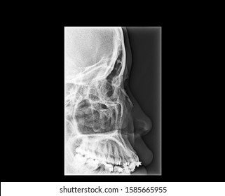 X Ray Sinus Images Stock Photos Vectors Shutterstock