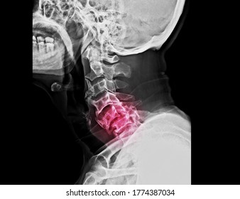 A Lateral Projection Cervical Spine X-ray Showing Bilateral Facet Joint Dislocation Causing Spinal Cord Injury In A Patient With Car Accident. The Patient Needs Surgical Decompression And Reduction.