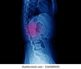 Lateral Projection Lumbar Spine X-ray Showing Compression Fracture At L1 Vertebra With Mild Degree Height Loss. The Patient Had Severe Back Pain And Needed Extension Brace For Treatment.