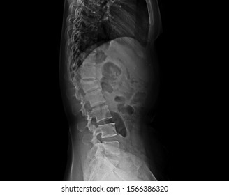 Lateral Projection Lumbar Spine X-ray Showing Compression Fracture At L1 Vertebra With Mild Degree Height Loss. The Patient Had Severe Back Pain And Needed Extension Brace For Treatment.