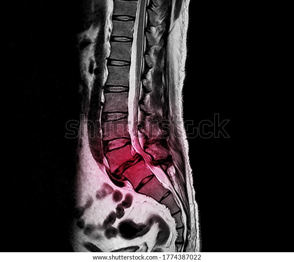 A lateral projection of lumbar spine x-ray\
showing degenerative spondylolisthesis at L5/S1 level that causes\
low back pain and sciatica. The patient needs surgical\
decompression and spinal\
fusion.