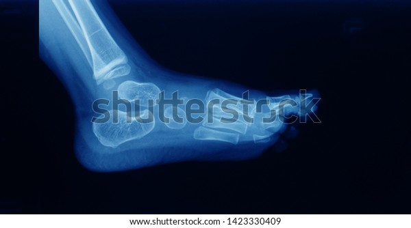 Lateral projection x-ray of foot and ankle of a\
child with clubfoot showing cavus foot or high arch foot. The\
deformity is a component of clubfoot or talipes equinovarus.\
Congenital or birth\
defect.
