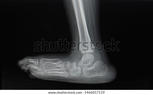 rocker bottom foot radiology