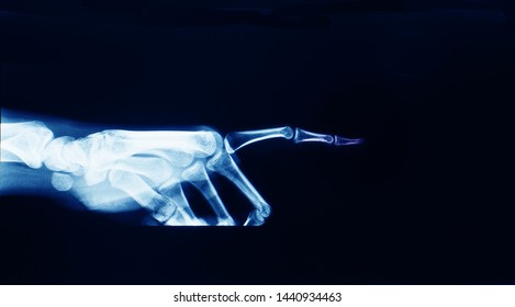 Lateral Projection X-ray Of Hand And Index Finger Showing The Finger Pointing At Something. The Finger Is Like The Famous Extra-territorial Or ET Finger.