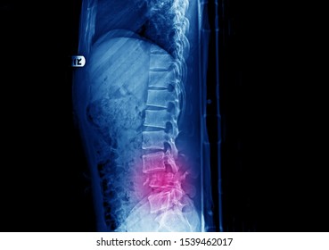 Lateral Projection X-ray Of Lumbar Spine Showing Unstable Fracture And Dislocation Of L4 Vertebra After Accident. The Patient Had Severe Back Pain And Cauda Equina Syndrome. 