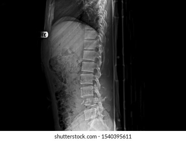 Lateral Projection X-ray Of Lumbar Spine Showing Unstable Fracture And Dislocation Of L4 Vertebra After Accident. The Patient Had Severe Back Pain And Cauda Equina Syndrome. 