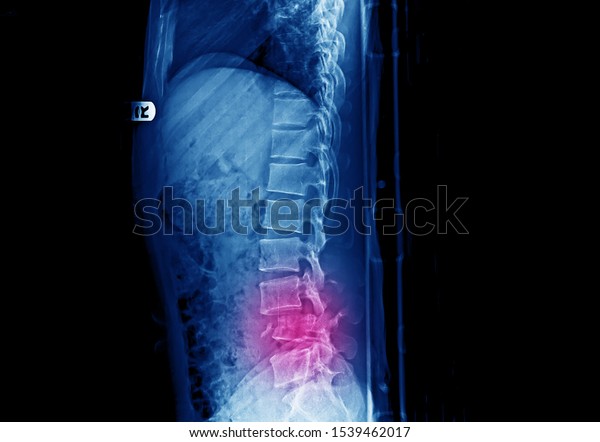 Lateral projection\
X-ray of lumbar spine showing unstable fracture and dislocation of\
L4 vertebra after accident. The patient had severe back pain and\
cauda equina syndrome. 