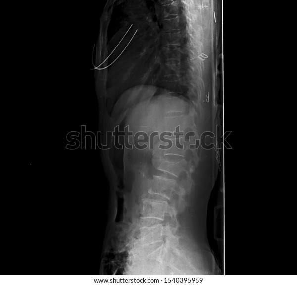 Lateral Projection Xray Thoracolumbar Spine Showing Stock Photo ...