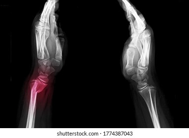 537 Distal radius x ray Images, Stock Photos & Vectors | Shutterstock