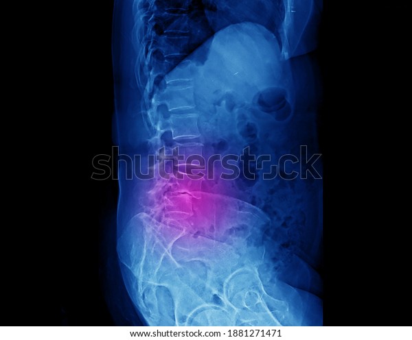 A lateral radiograph of lumbar spine showing\
degenerative spondylolisthesis of L4-5 that causes spinal canal\
stenosis and low back pain. The patient needs decompression and\
spinal fusion surgery.