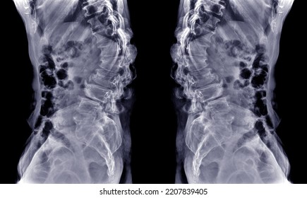 Lateral Vertebral L-S X-ray To Diagnose Spinal Curvature.