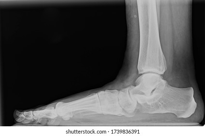 Lateral view foot x-ray showing severe flat foot deformity