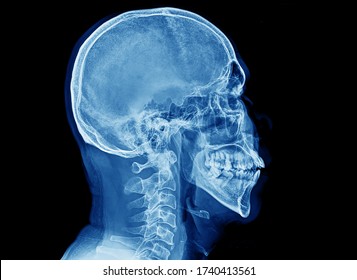 A lateral view of skull and cervical spine x-ray showing normal bones and joints. There is no fracture, cancer or myeloma lesions. This patient has headache and neck pain.
