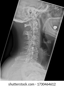 Lateral View Xray Cervical Spine Showing Stock Photo (Edit Now) 1730464612