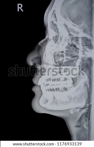 Lateral View Xray Image Nasal Bone Stock Photo (Edit Now) 1176933139