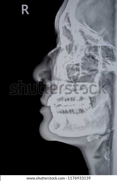 Lateral View Xray Image Nasal Bone Stock Photo (Edit Now) 1176933139
