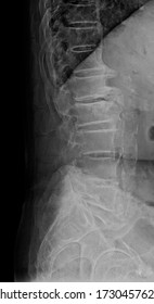 Lateral view x-ray showing pronounced osseous changes with syndesmophytes and osteochondrosis in ankylosing spondylitis