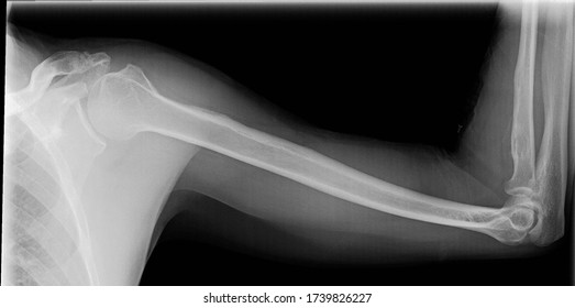Lateral view x-ray of upper extremity - Shutterstock ID 1739826227