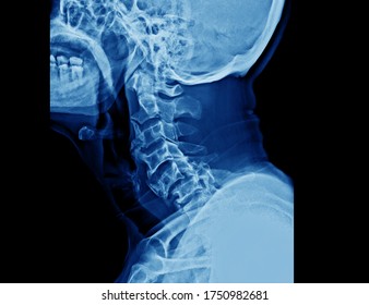 A Lateral X-ray Of Cervical Spine Showing Bilateral Facet Joint Dislocation And Deformity Of Spine. This Patient Has Spinal Cord Injury And Needs Emergent Reduction And Then Surgical Decompression.