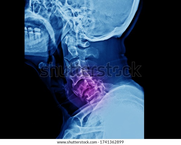 A lateral x-ray of cervical spine showing\
bilateral facet joint dislocation and deformity of spine. This\
patient has spinal cord injury and needs emergent reduction and\
then surgical decompression.