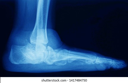 Lateral X-ray Of Foot And Ankle Show Flat Foot Or Fallen Arch. The Arch Of Foot Was Collapsed. Pes Planus.