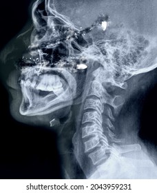 Lateral X-ray Gunshot Wound To The Head