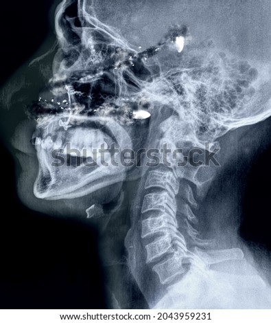 lateral x-ray gunshot wound to the head