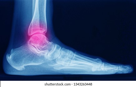 a lateral x-ray or radiograph of an ankle showing anatomy of bones and joint of ankle and foot in a patient with ankle sprain. the red highlight focused on the ankle joint. 
