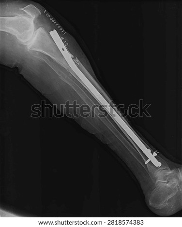 Lateral X-ray view of human lower leg showing intramedullary rod insertion for tibia fracture stabilization and skin staples