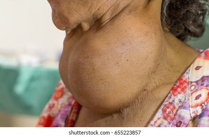 Lateral Zooming Closeup View Of Enlarged Thyroid Gland On Old Asian Female 's Neck Attended With Slow Progressive Growing Neck Lump And Upper Airway Obstruction