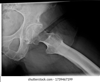 Lauenstein view hip x-ray showing advanced osteoarthritis of the left hip needing arthroplasty
