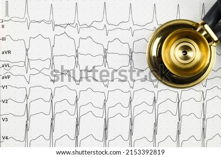 Layout: on the ECG table with rhythm disturbance - atrial flutter,stethophonendoscope.Top view. Close-up.High quality photo