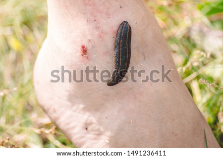 A leech close - up and a leech bite wound on a man's leg.A trace of a medical leech sucker on the human body.Treatment with leeches.The use of medical leeches. Photo.Close up.
