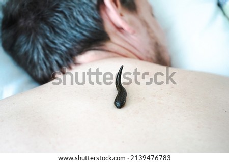 A leech sucks blood on the back of a patient in a hirudotherapy salon 