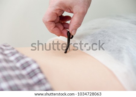 Leech therapy. A session of hirudotherapy