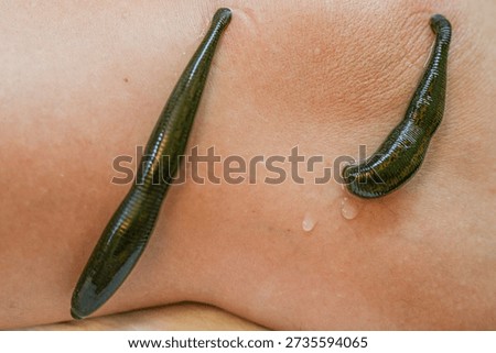 Leech worm attaching to human leg skin during an alternative medicine hirudotherapy procedure, used for specific medical treatment by sucking blood and releasing beneficial enzymes