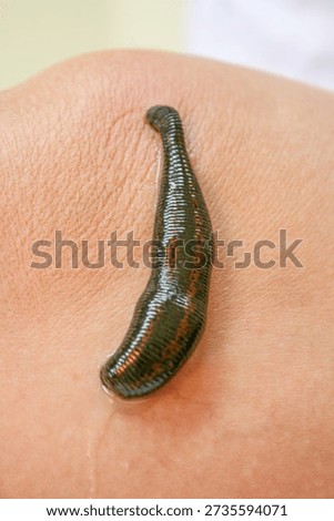 Leech worm attaching to human leg skin during an alternative medicine hirudotherapy procedure, used for specific medical treatment by sucking blood and releasing beneficial enzymes