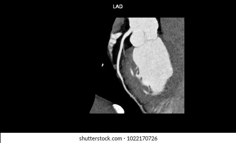 Left Anterior Descending (LAD, Interventricular) Artery Branches Curve With Computed Tomography Angiography, CTA Coronary Angiogram