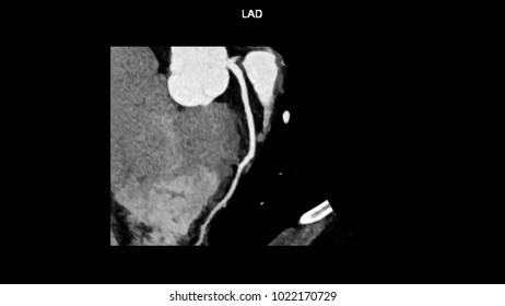 Left Anterior Descending (LAD, Interventricular) Artery Branches Curve With Computed Tomography Angiography, CTA Coronary Angiogram